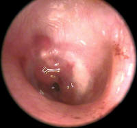 Ear Tube Granuloma - Granulation Tissue