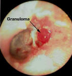 Mastoid Cholesteatoma with a Granuloma
