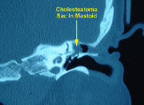 CT Scan of a Mastoid Cholesteatoma