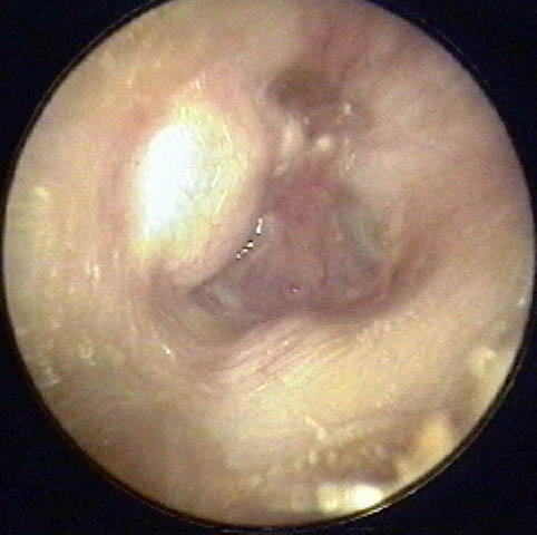 Prolapse of Anterior Ear Canal
