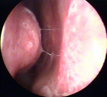 Pale Nasal Mucosa in a Patient with Allergic Rhinitis