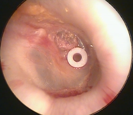 Ear Tube Placement with Eversion of Retraction Pocket