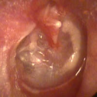 Middle Ear Valsalva with a Retracted Eardrum and a Myringostapediopexy