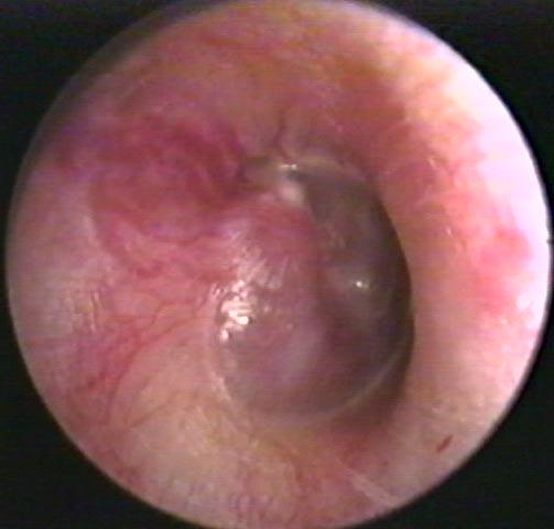 Appearance of a Glomus Tympanicum as seen through a right eardrum.