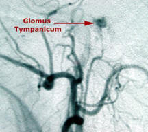 MRA of a Glomus Tympanicum