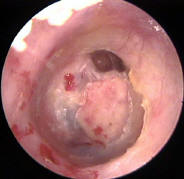 Retracion Pocket and Cartilage Graft for an Ossicular Prosthesis