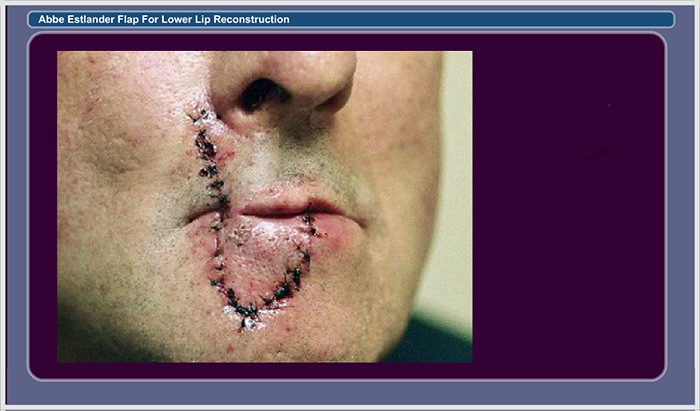 Slide 6. One Day Postoperative Appearance