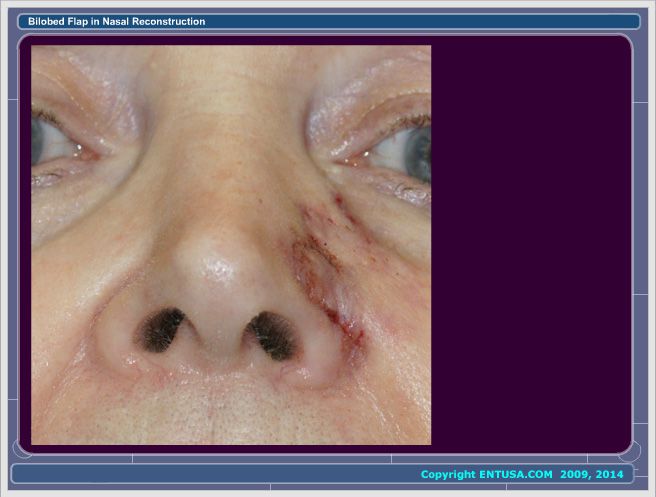 Slide 7. Postoperative Appearance of Nose
