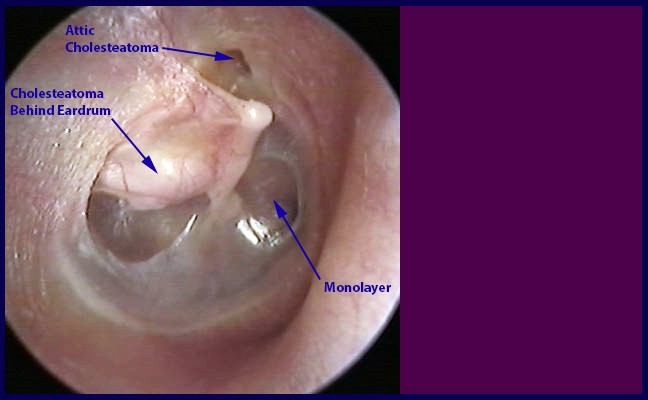 15.  Attic Cholesteoma Extending Into The Middle Ear