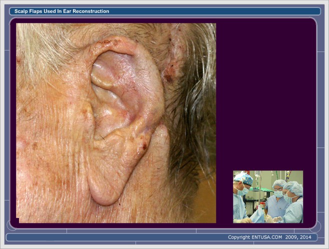 Slide 18. Ear Reconstruction - Post-Op Stage 2