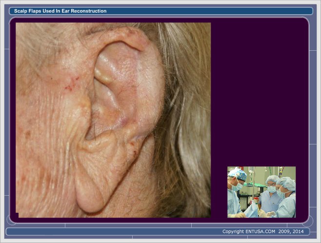 Slide 19. Ear Reconstruction - Post-Op Stage 2