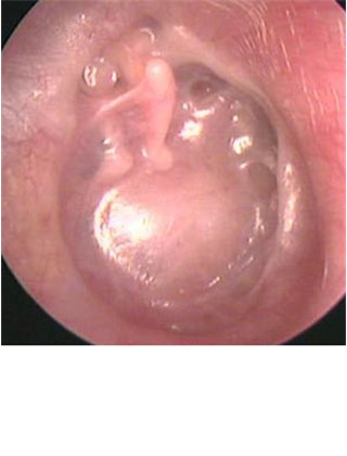 1.  Severe Atelectasis of the Eardrum