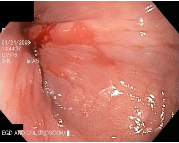 11.  Gastric Mucosa in the Lower Esophagus - Barrett's Esophagus