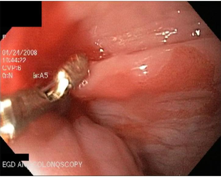 12.  Biopsy of Barrett's Esophageal Mucosa