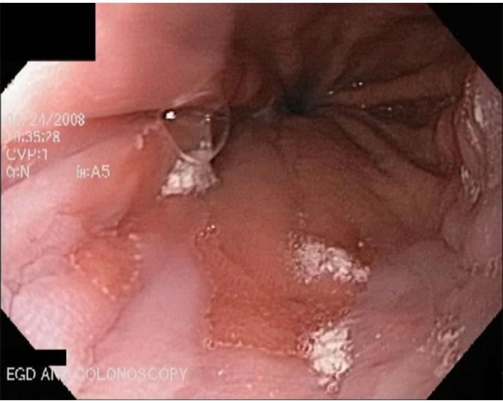 3.  Gastroesophageal Junction - Barrett's Esophagus