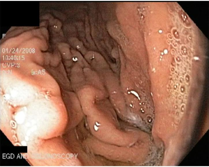 4.  Gastric (Stomach) Mucoas with Large Folds or Rugae 
