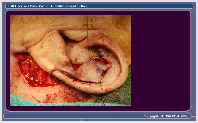 Slide 6. Placement of Full-Thickness Skin Graft