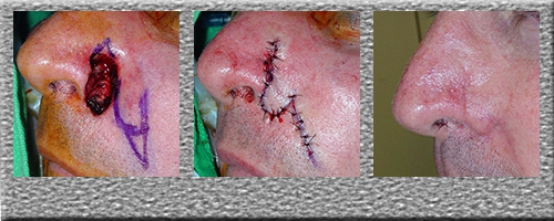 Superior Nasolabial Flap - Click Here to View Pictures