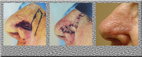 Inferior Nasolabial Flap - Click Here to View Pictures