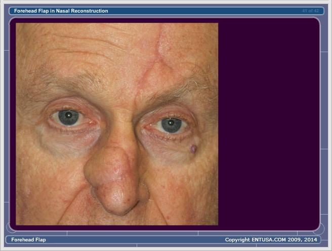 Slide 20. Forehead Flap - Stage 2