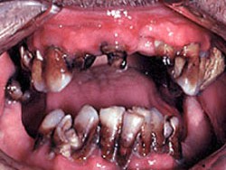 1. methamphetamine and dental caries