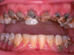 3. methamphetamine and dental caries