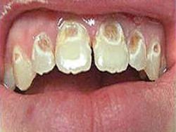 5. methamphetamine and dental caries