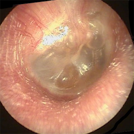 1.  Right Eardrum With Chronic Serous Otitis Media - After Middle Ear Valsalva