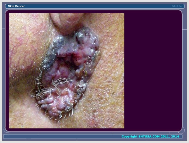 Slide 6.  Basal Cell Carcinoma