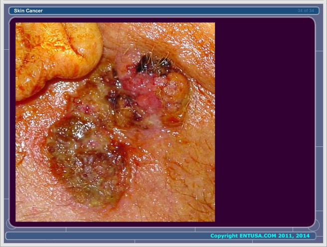 Slide 9.  Squamous Cell Carcinoma