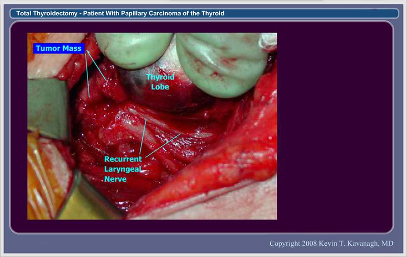 11.  Superior Exposure of Recurrent Laryngeal Nerve