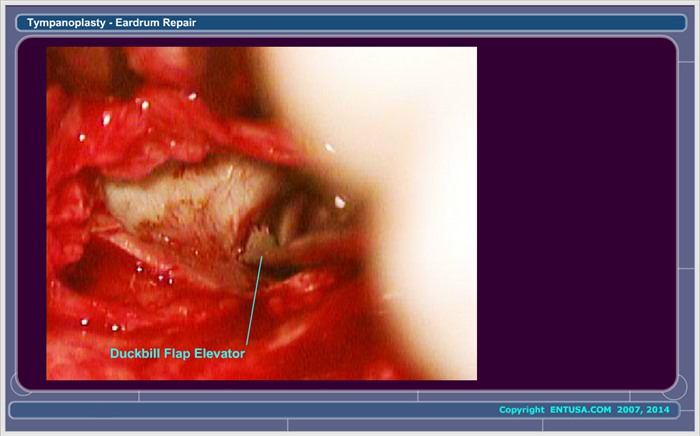 20.  Incision of the Ear Canal Skin