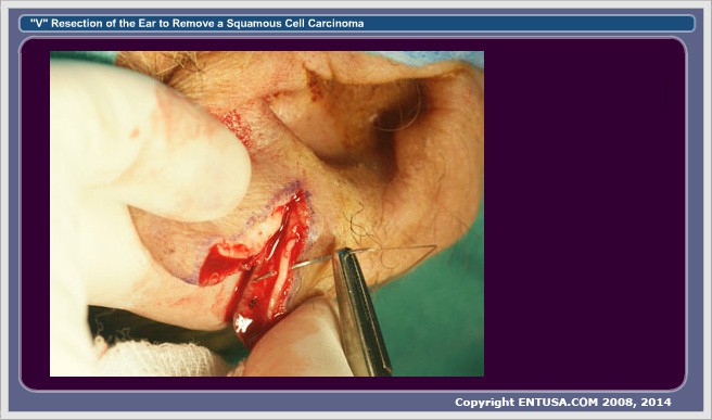 7. Cartilage Closed