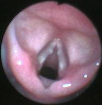 Vocal Cord Nodules