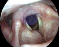 Right anterior laryngocele in a 64 year old female