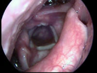 Bilateral True Vocal Cord Paralysis - Larynx