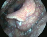 Epiglottic Mucosal Cyst