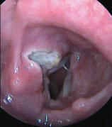 T3 Squamous Cell Carcinoma with Fixation of the Left True Vocal Cords