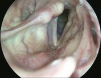 Right True Vocal Cord paralysis - Compenstated