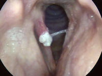 T1 Carcinoma of the True Vocal Cord - Larynx