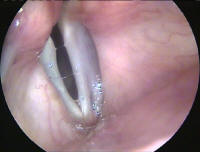 Bilateral True Vocal Cord Paralysis