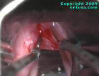 Removal of a Supraglottic Cyst of the Larynx