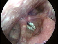 Bilateral Vocal Cord Nodules