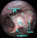 Pyriform Sinus and Larynx Cancer