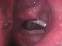Vocal Cord Paralysis - Larynx