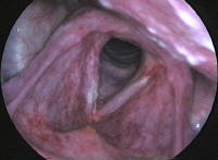 Recurrent T1 Carcinoma of the Larynx