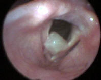 Large Larynx Polyp Arising From the Ventricle