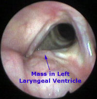 Lymphoma of Larynx