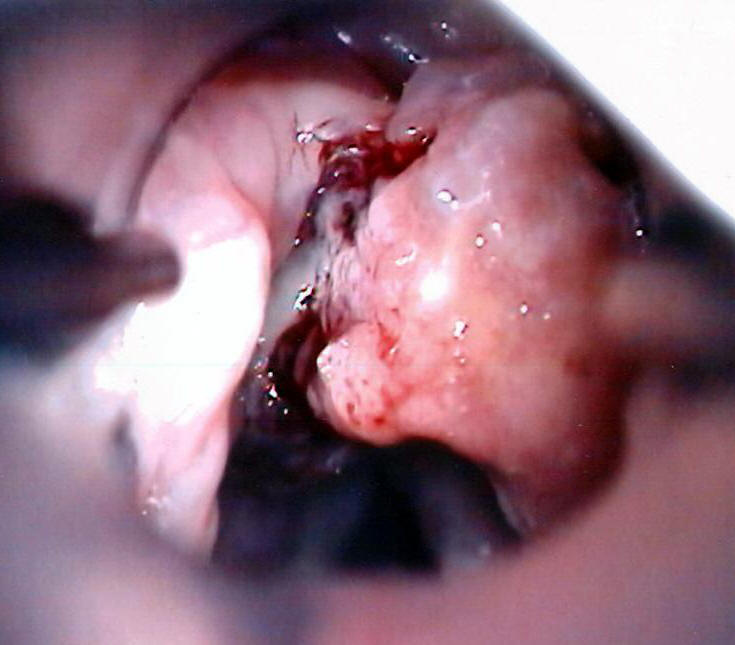 Supraglottic Cancer of the Larynx from Smoking
