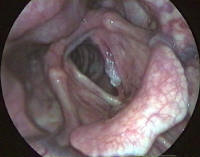 Larynx Cancer T1